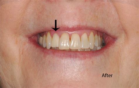 temporary dental crown replacement